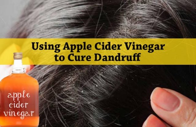 How to use apple cider vinegar for dandruff