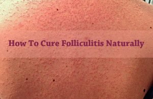 15 Natural Home Remedies for Folliculitis Cure – Signs, Symptoms & Treatment Home Remedies for Folliculitis Cure