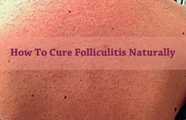 Home Remedies for Folliculitis Cure