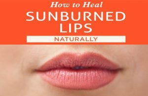 15 Home Remedies To Help You Alleviate Discomfort Caused By Sunburnt Lips Home Remedies for Sunburnt Lips