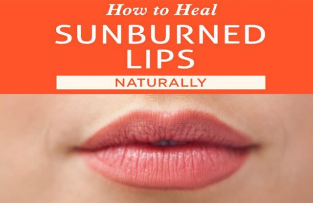 Home Remedies for Sunburnt Lips