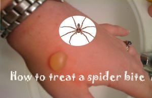 15 Home Remedies to Treat a Spider Bite Quickly at Home How to Treat a Spider Bite at Home