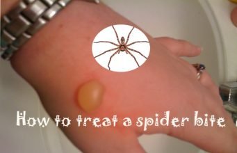 15 Home Remedies to Treat a Spider Bite Quickly at Home How to Treat a Spider Bite at Home