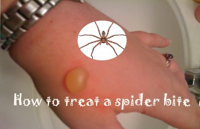 How to Treat a Spider Bite at Home