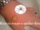 15 Home Remedies to Treat a Spider Bite Quickly at Home How to Treat a Spider Bite at Home