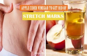 How to Remove Stretch Marks with Apple Cider Vinegar