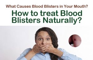 15 Easy Home Remedies to Get Rid of Blood Blisters in the Mouth Home Remedies to Get Rid of Blood Blisters in the Mouth
