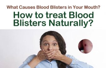 15 Easy Home Remedies to Get Rid of Blood Blisters in the Mouth Home Remedies to Get Rid of Blood Blisters in the Mouth