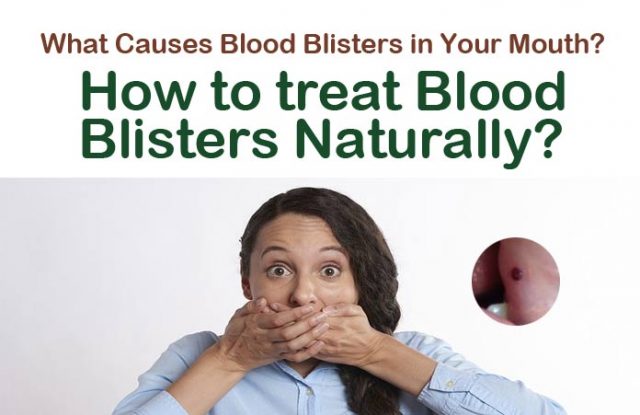 Home Remedies to Get Rid of Blood Blisters in the Mouth