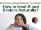 15 Easy Home Remedies to Get Rid of Blood Blisters in the Mouth Home Remedies to Get Rid of Blood Blisters in the Mouth