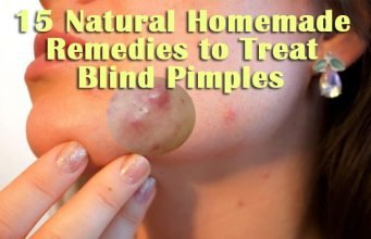 15 Natural Homemade Remedies to Treat Blind Pimples Under Skin Quickly Natural Home Remedies to Treat Blind Pimples