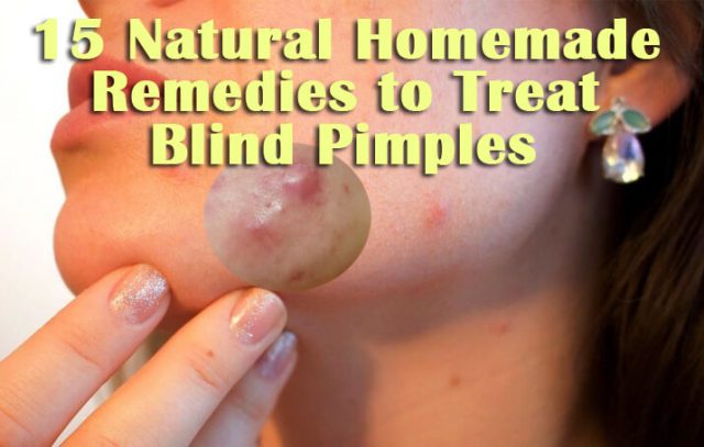 Natural Home Remedies to Treat Blind Pimples