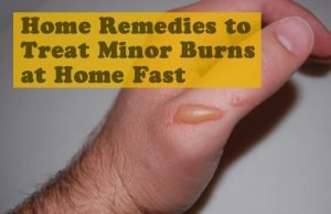 15 Effective Home Remedies to Treat Minor Burns at Home Fast Home Remedies to Treat Minor Burns at Home Fast