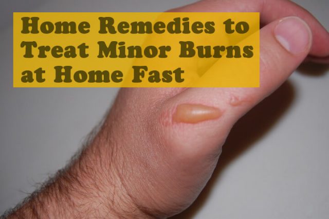 Home Remedies to Treat Minor Burns at Home Fast