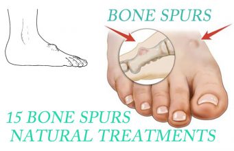 15 Bone Spurs (Neck And Knee) Natural Treatments That Work Bone Spurs (Neck And Knee) Natural Treatments
