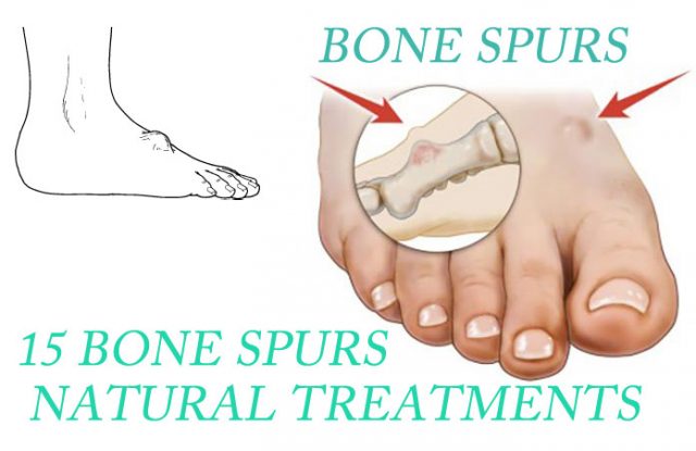 Bone Spurs (Neck And Knee) Natural Treatments