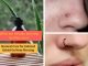 10 Natural Home Remedies For Curing Infected Keloid On Nose Piercing Home Remedies For HPV Genital Warts Treatment