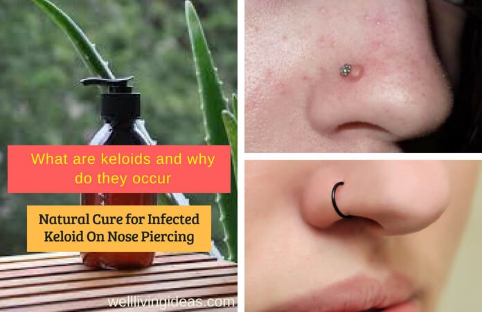 Curing Infected Keloid On Nose Piercing