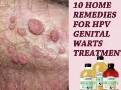 10 Home Remedies For HPV Genital Warts Treatment – (Best Apple Cider Vinegar) 10 Home Remedies For HPV Genital Warts Treatment