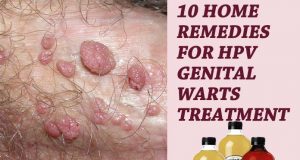 10 Home Remedies For HPV Genital Warts Treatment – (Best Apple Cider Vinegar) 10 Home Remedies For HPV Genital Warts Treatment