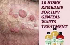 10 Home Remedies For HPV Genital Warts Treatment – (Best Apple Cider Vinegar) 10 Home Remedies For HPV Genital Warts Treatment