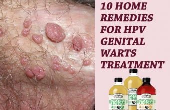 10 Home Remedies For HPV Genital Warts Treatment – (Best Apple Cider Vinegar) 10 Home Remedies For HPV Genital Warts Treatment