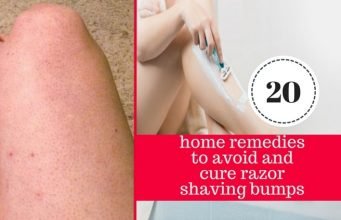 20 Quick and Easy Home Remedies to Get Rid of Razor Bumps and Burns Fast