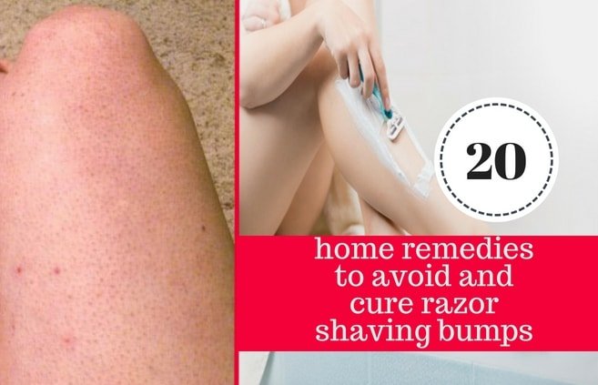 home remedies cure razor shaving bumps