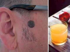 Apple Cider Vinegar Mole Removal Natural Remedy Apple Cider Vinegar Body Mole Removal Natural Remedy