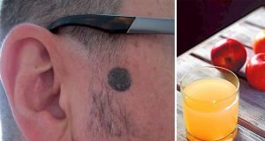 Apple Cider Vinegar Mole Removal Natural Remedy Apple Cider Vinegar Body Mole Removal Natural Remedy