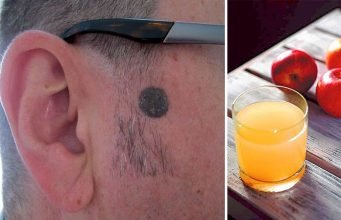 Apple Cider Vinegar Mole Removal Natural Remedy Apple Cider Vinegar Body Mole Removal Natural Remedy