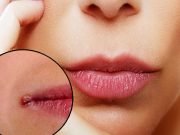 12 Home Remedies to Heal Cracked Lip Corners Fast that Really Work Home Remedies to Heal Cracked Lip Corners