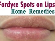 14 Home Remedies For Fordyce Spots On Lips Treatment Home Remedies For Fordyce Spots On Lips