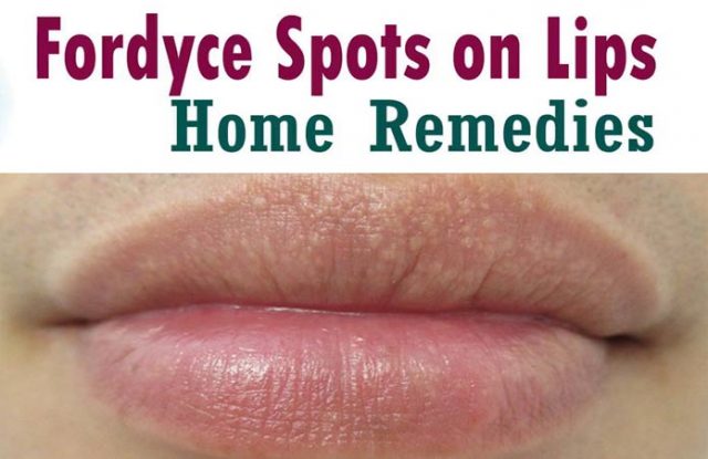 Home Remedies For Fordyce Spots On Lips