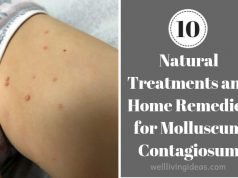 10 Natural Treatments and Home Remedies for Molluscum Contagiosum Home Remedies for Molluscum Contagiosum kids