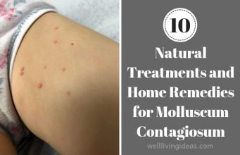 10 Natural Treatments and Home Remedies for Molluscum Contagiosum Home Remedies for Molluscum Contagiosum kids