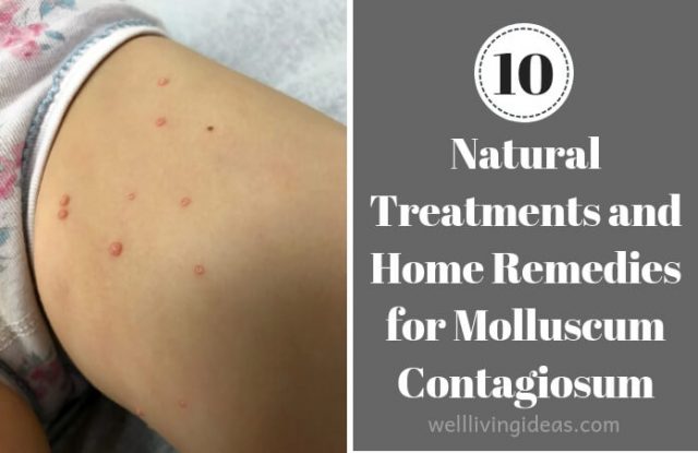 Home Remedies for Molluscum Contagiosum kids