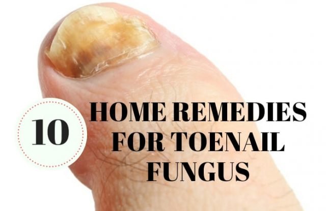 Home Remedies for toenail fungus Cure
