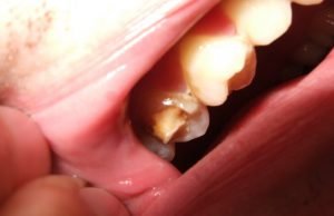 10 Easy Home Remedies To Stop Broken Tooth Pain Naturally Home Remedies To Stop Broken Tooth Pain