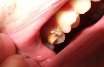 10 Easy Home Remedies To Stop Broken Tooth Pain Naturally Home Remedies To Stop Broken Tooth Pain