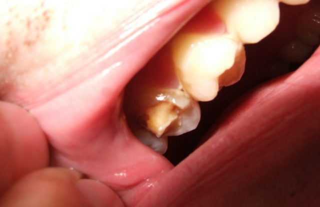Home Remedies To Stop Broken Tooth Pain